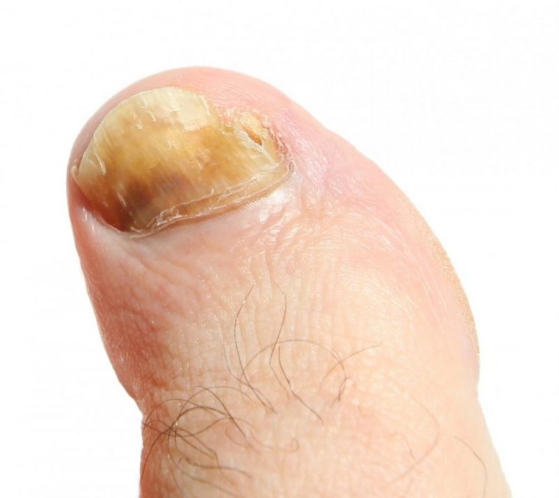 Грибок на ногах - симптомы заболевания и эффективное лечение в домашних условиях