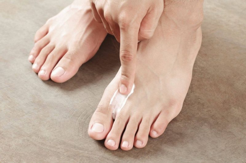 Грибок на ногах - симптомы заболевания и эффективное лечение в домашних условиях