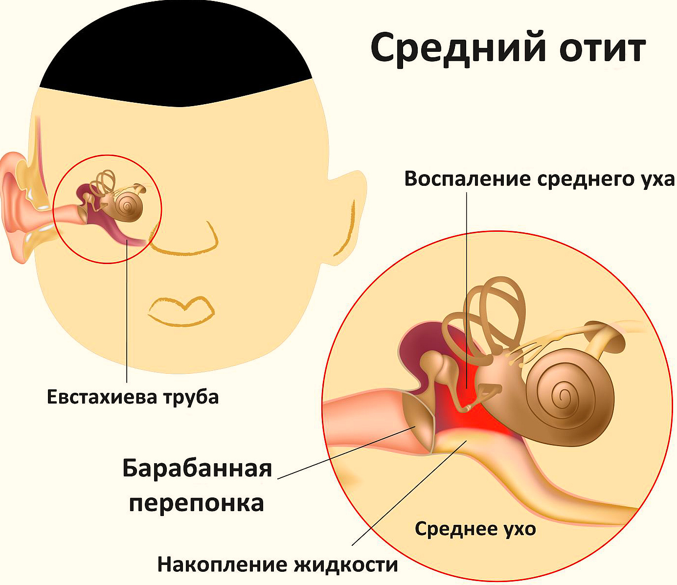 Воспаление уха у ребенка - что делать в первую очередь